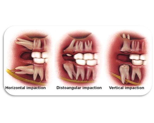 Wisdom Tooth & 3rd Molar Extraction