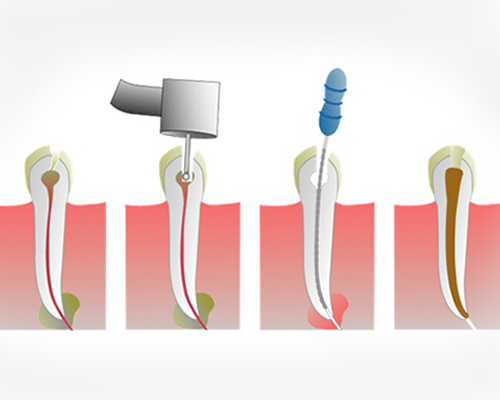 Root Canal Treatment 